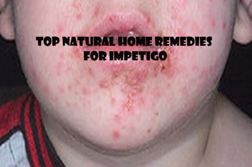 Top Natural Home Remedies for Impetigo